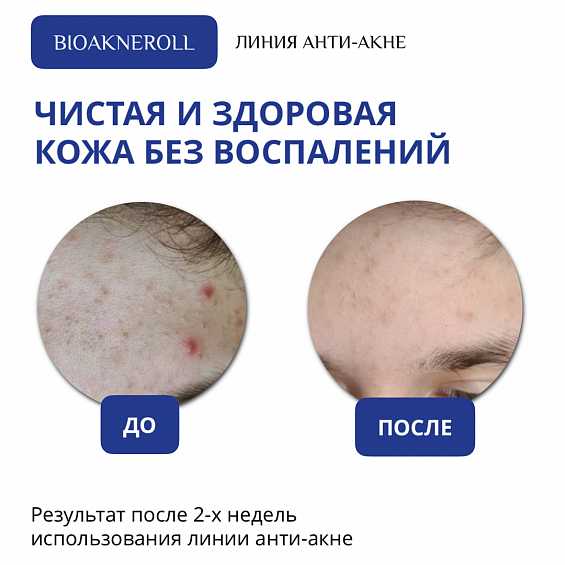 Анти-акне лосьон для ухода за проблемной кожей лица "Bioakneroll"