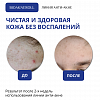 Анти-акне маска-концентрат "Bioakneroll" для ухода за проблемной кожей лица